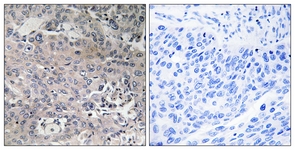 IHC of paraffin-embedded human breast carcinoma tissue, using TUFM Antibody. The picture on the right is treated with the synthesized peptide.