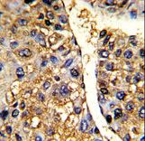 Formalin-fixed and paraffin-embedded human hepatocarcinoma reacted with TUFM Antibody , which was peroxidase-conjugated to the secondary antibody, followed by DAB staining. This data demonstrates the use of this antibody for immunohistochemistry; clinical relevance has not been evaluated.