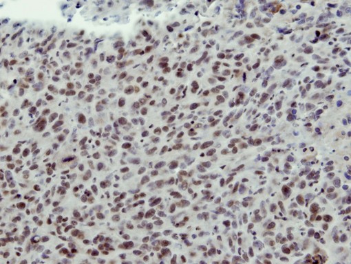 IHC of paraffin-embedded HS578T xenograft using CLP1 antibody at 1:100 dilution.