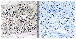 IHC of paraffin-embedded human breast carcinoma tissue, using EHHADH Antibody. The picture on the right is treated with the synthesized peptide.