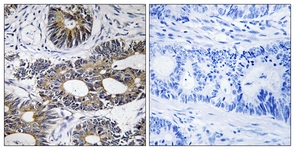 IHC of paraffin-embedded human colon carcinoma tissue, using EIF1AY Antibody. The picture on the right is treated with the synthesized peptide.