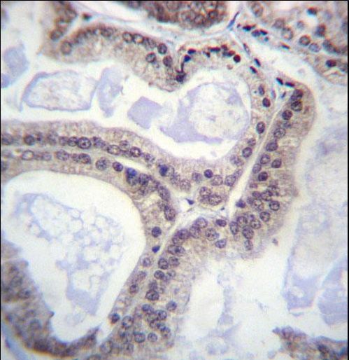 EIF1AY Antibody immunohistochemistry of formalin-fixed and paraffin-embedded human prostate carcinoma followed by peroxidase-conjugated secondary antibody and DAB staining.