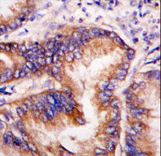 Formalin-fixed and paraffin-embedded human lung carcinoma tissue reacted with EIF2AK1 antibody , which was peroxidase-conjugated to the secondary antibody, followed by DAB staining. This data demonstrates the use of this antibody for immunohistochemistry; clinical relevance has not been evaluated.
