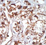Formalin-fixed and paraffin-embedded human cancer tissue reacted with the primary antibody, which was peroxidase-conjugated to the secondary antibody, followed by AEC staining. This data demonstrates the use of this antibody for immunohistochemistry; clinical relevance has not been evaluated. BC = breast carcinoma; HC = hepatocarcinoma.
