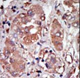 Formalin-fixed and paraffin-embedded human cancer tissue reacted with the primary antibody, which was peroxidase-conjugated to the secondary antibody, followed by DAB staining. This data demonstrates the use of this antibody for immunohistochemistry; clinical relevance has not been evaluated. BC = breast carcinoma; HC = hepatocarcinoma.