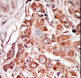 Formalin-fixed and paraffin-embedded human cancer tissue reacted with the primary antibody, which was peroxidase-conjugated to the secondary antibody, followed by DAB staining. This data demonstrates the use of this antibody for immunohistochemistry; clinical relevance has not been evaluated. BC = breast carcinoma; HC = hepatocarcinoma.