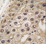 Formalin-fixed and paraffin-embedded human hepatocarcinoma tissue reacted with PERK antibody (N-term Q163) , which was peroxidase-conjugated to the secondary antibody, followed by DAB staining. This data demonstrates the use of this antibody for immunohistochemistry; clinical relevance has not been evaluated.