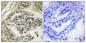 IHC of paraffin-embedded human prostate carcinoma, using PEK/PERK (Phospho-Thr981) Antibody. The sample on the right was incubated with synthetic peptide.