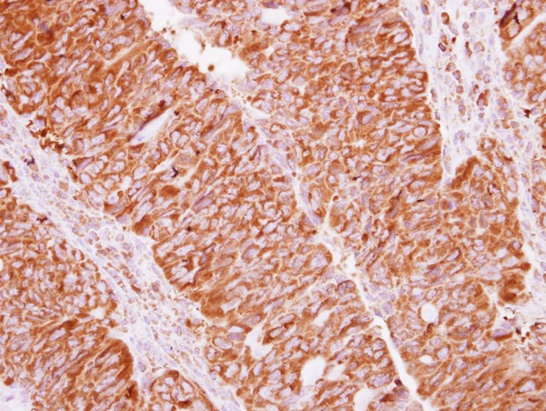 IHC of paraffin-embedded Colon ca, using EIF2 beta antibody at 1:500 dilution.