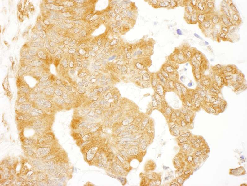 Detection of Human EIF3S9/eIF3B by Immunohistochemistry. Sample: FFPE section of human ovarian carcinoma. Antibody: Affinity purified rabbit anti-EIF3S9/eIF3B used at a dilution of 1:200 (1 Detection: DAB.