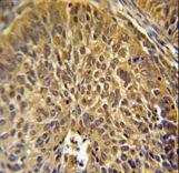 EIF3G Antibody immunohistochemistry of formalin-fixed and paraffin-embedded human cervix carcinoma followed by peroxidase-conjugated secondary antibody and DAB staining.