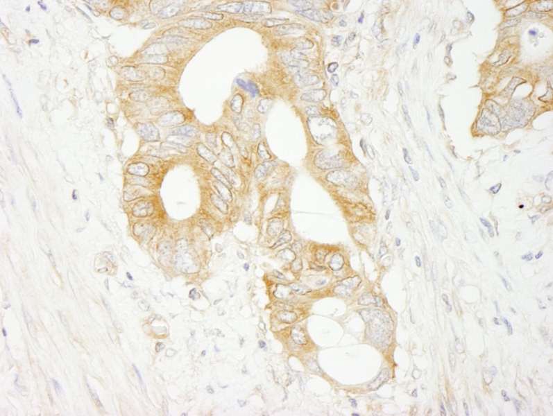 Detection of Human eIF3J/EIF3S1 by Immunohistochemistry. Sample: FFPE section of human colon carcinoma. Antibody: Affinity purified rabbit anti-eIF3J/EIF3S1 used at a dilution of 1:500.