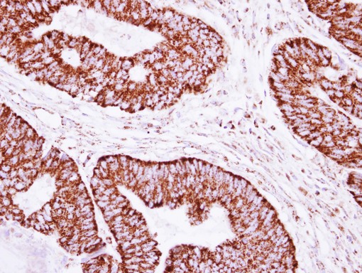 IHC of paraffin-embedded Colon ca, using CLPP antibody at 1:250 dilution.