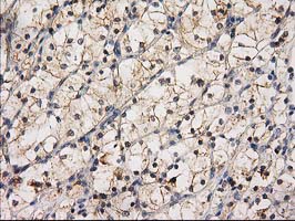 IHC of paraffin-embedded Carcinoma of Human kidney tissue using anti-EIF4E2 mouse monoclonal antibody. (Heat-induced epitope retrieval by 10mM citric buffer, pH6.0, 100C for 10min).
