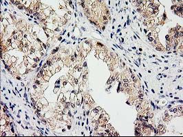 IHC of paraffin-embedded Adenocarcinoma of Human ovary tissue using anti-EIF4E2 mouse monoclonal antibody. (Heat-induced epitope retrieval by 10mM citric buffer, pH6.0, 100C for 10min).
