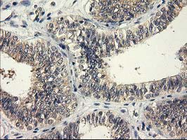 IHC of paraffin-embedded Adenocarcinoma of Human endometrium tissue using anti-EIF4E2 mouse monoclonal antibody. (Heat-induced epitope retrieval by 10mM citric buffer, pH6.0, 100C for 10min).