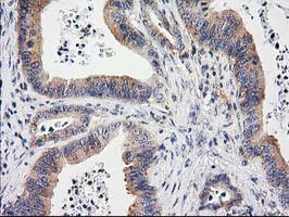 IHC of paraffin-embedded Adenocarcinoma of Human colon tissue using anti-EIF4E2 mouse monoclonal antibody. (Heat-induced epitope retrieval by 10mM citric buffer, pH6.0, 100C for 10min).