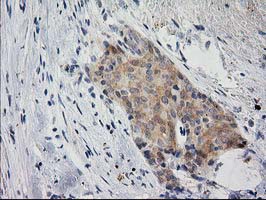IHC of paraffin-embedded Adenocarcinoma of Human breast tissue using anti-EIF4E2 mouse monoclonal antibody. (Heat-induced epitope retrieval by 10mM citric buffer, pH6.0, 100C for 10min).