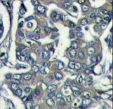 Formalin-fixed and paraffin-embedded human breast carcinoma reacted with EIF4E2 Antibody , which was peroxidase-conjugated to the secondary antibody, followed by DAB staining. This data demonstrates the use of this antibody for immunohistochemistry; clinical relevance has not been evaluated.