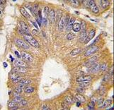 Formalin-fixed and paraffin-embedded human colon carcinoma tissue reacted with EIF4EBP1 Antibody (T69) , which was peroxidase-conjugated to the secondary antibody, followed by DAB staining. This data demonstrates the use of this antibody for immunohistochemistry; clinical relevance has not been evaluated.