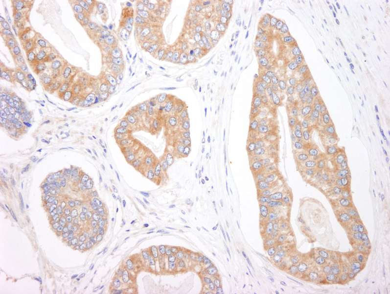 Detection of Human 4E-T by Immunohistochemistry. Sample: FFPE section of human prostate carcinoma. Antibody: Affinity purified rabbit anti-4E-T used at a dilution of 1:1000 (1 ug/ml).