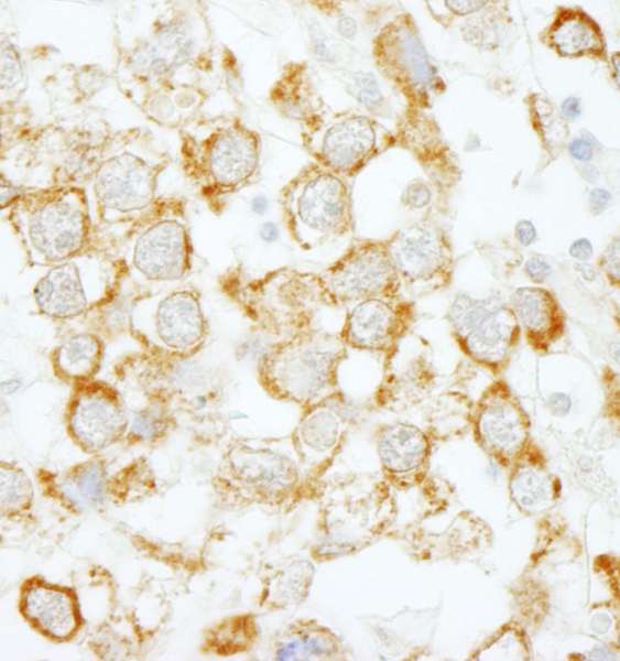 Detection of Human eIF4H by Immunohistochemistry. Sample: FFPE section of human testicular seminoma. Antibody: Affinity purified rabbit anti-eIF4H used at a dilution of1:200 (1Detection: DAB.