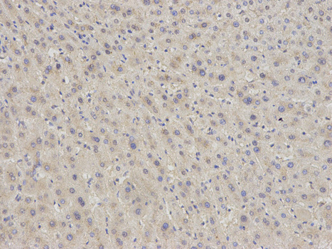 Immunohistochemistry of paraffin-embedded human kidney cancer using EIF5A antibody at dilution of 1:200 (200x lens).