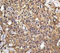 IHC of paraffin-embedded human urinary bladder carcinoma using anti-eIF-5alpha antibody.