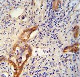 CLPX antibody immunohistochemistry of formalin-fixed and paraffin-embedded human hepatocarcinoma followed by peroxidase-conjugated secondary antibody and DAB staining.