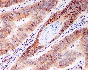 IHC of paraffin-embedded human ovarian carcinoma using anti-eIF5A2 antibody.