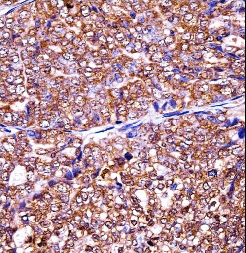 EIF5A2 Antibody immunohistochemistry of formalin-fixed and paraffin-embedded human ovarian carcinoma followed by peroxidase-conjugated secondary antibody and DAB staining.
