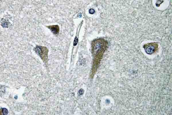 IHC of eIF5B (H1086) pAb in paraffin-embedded human breast carcinoma tissue.