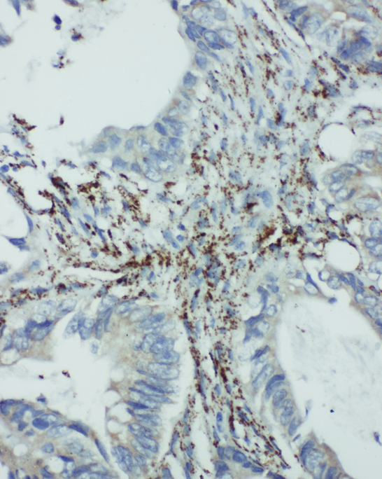 EIF6 antibody. IHC(P): Human Intestinal Cancer Tissue.