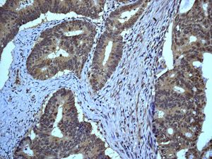 IHC of paraffin-embedded human colonic adenocarcinoma using anti-eIF-6 antibody.