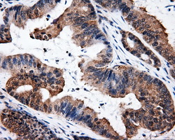 IHC of paraffin-embedded Adenocarcinoma of colon tissue using anti-ELAVL1 mouse monoclonal antibody. (Dilution 1:50).