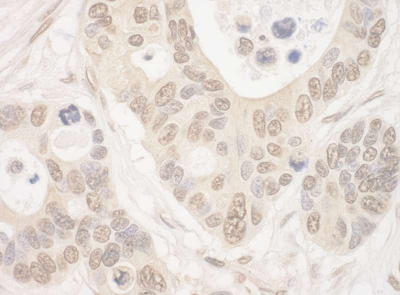 Detection of Human ELF2 by Immunohistochemistry. Sample: FFPE section of human ovarian carcinoma. Antibody: Affinity purified rabbit anti- ELF2 used at a dilution of 1:1000 (1 ug/mg).