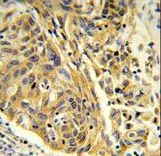 Formalin-fixed and paraffin-embedded human lung carcinoma reacted with CLTA Antibody , which was peroxidase-conjugated to the secondary antibody, followed by DAB staining. This data demonstrates the use of this antibody for immunohistochemistry; clinical relevance has not been evaluated.