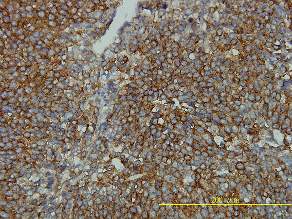 Immunoperoxidase of monoclonal antibody to CLTB on formalin-fixed paraffin-embedded human transitional cell carcinoma tissue. [antibody concentration 2 ug/ml].