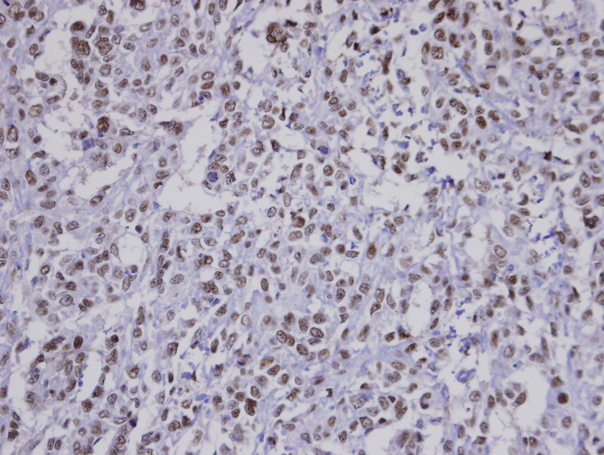 IHC of paraffin-embedded Saos-2 xenograft using FBXO43 antibody at 1:100 dilution.