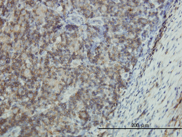 Immunoperoxidase of monoclonal antibody to EMP3 on formalin-fixed paraffin-embedded human lymphoma tissue. [antibody concentration 3 ug/ml].