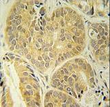 ENAM antibody immunohistochemistry of formalin-fixed and paraffin-embedded human prostate carcinoma followed by peroxidase-conjugated secondary antibody and DAB staining.