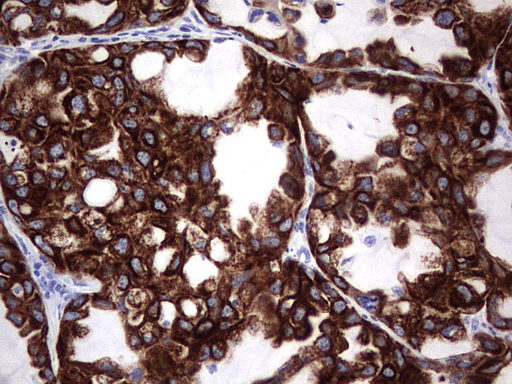 IHC of paraffin-embedded Carcinoma of Human lung tissue using anti-ENKUR mouse monoclonal antibody. (Heat-induced epitope retrieval by 1 mM EDTA in 10mM Tris, pH8.5, 120°C for 3min).