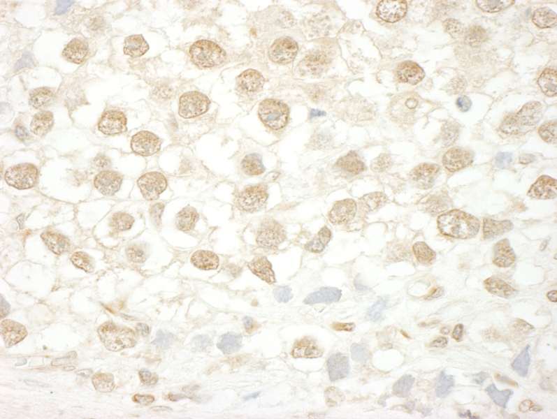 Detection of Human MLLT1 by Immunohistochemistry. Sample: FFPE section of human testicular seminoma. Antibody: Affinity purified rabbit anti-MLLT1 used at a dilution of 1:200 (1 ug/ml). Detection: DAB.