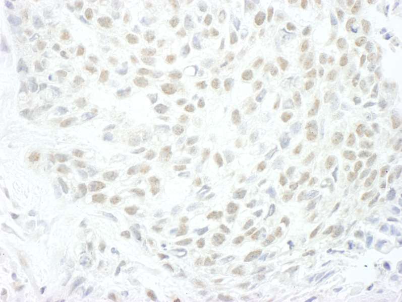Detection of Human MLLT1by Immunohistochemistry. Sample: FFPE section of human skin carcinoma. Antibody: Affinity purified rabbit anti-MLLT1 used at a dilution of 1:250.