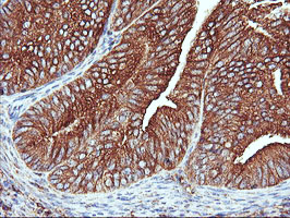 IHC of paraffin-embedded Adenocarcinoma of Human endometrium tissue using anti-ENPEP mouse monoclonal antibody. (Heat-induced epitope retrieval by 10mM citric buffer, pH6.0, 100C for 10min).