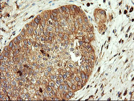 IHC of paraffin-embedded Carcinoma of Human bladder tissue using anti-ENPEP mouse monoclonal antibody. (Heat-induced epitope retrieval by 10mM citric buffer, pH6.0, 100C for 10min).