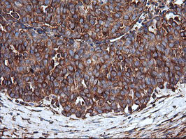 IHC of paraffin-embedded Adenocarcinoma of Human ovary tissue using anti-ENPEP mouse monoclonal antibody. (Heat-induced epitope retrieval by 10mM citric buffer, pH6.0, 100C for 10min).