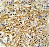 DC13 Antibody IHC of formalin-fixed and paraffin-embedded human breast carcinoma followed by peroxidase-conjugated secondary antibody and DAB staining.