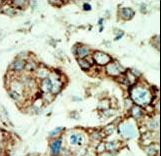 Formalin-fixed and paraffin-embedded human cancer tissue reacted with the primary antibody, which was peroxidase-conjugated to the secondary antibody, followed by AEC staining. This data demonstrates the use of this antibody for immunohistochemistry; clinical relevance has not been evaluated. BC = breast carcinoma; HC = hepatocarcinoma.