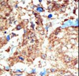 Formalin-fixed and paraffin-embedded human cancer tissue reacted with the primary antibody, which was peroxidase-conjugated to the secondary antibody, followed by DAB staining. This data demonstrates the use of this antibody for immunohistochemistry; clinical relevance has not been evaluated. BC = breast carcinoma; HC = hepatocarcinoma.